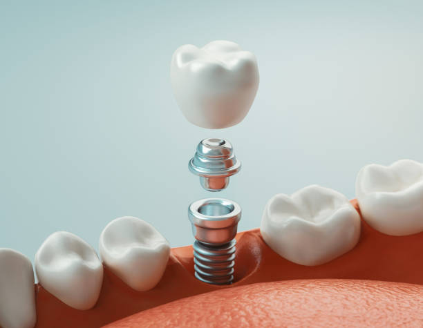 Are Dental Implants Safe in The Long Run for My Oral Health!