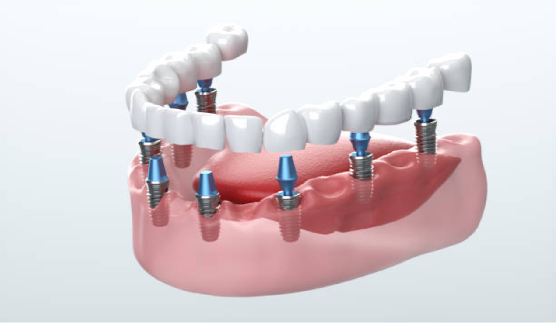 dental implant lake forest foothill ranch california