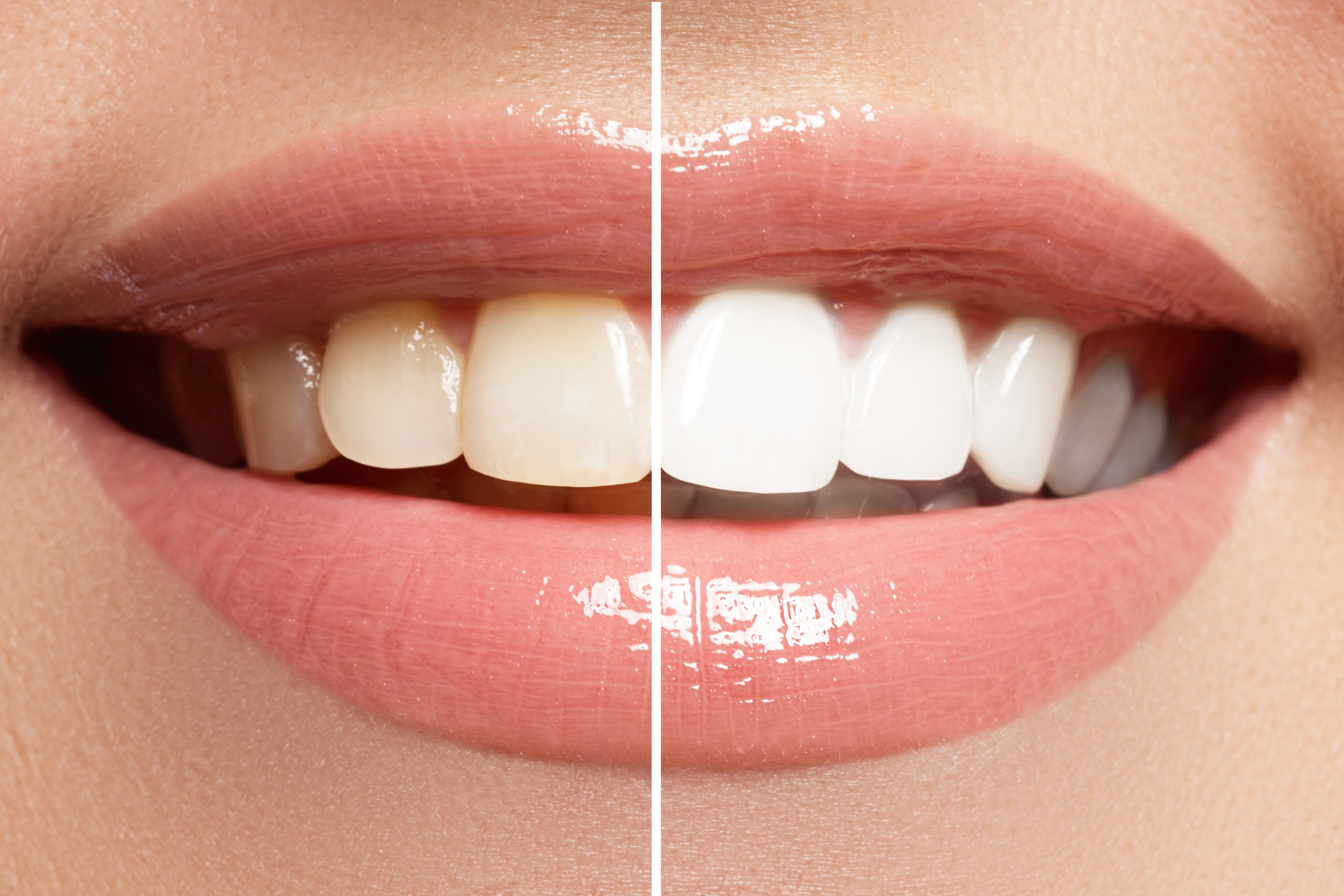 teethWhitening scaled