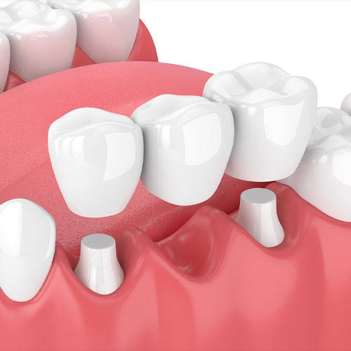 Dental Bridge at Baker Ranch Dental Spa & Implant Center Denti