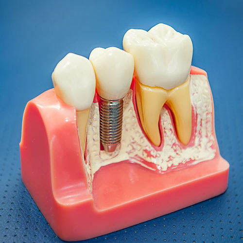 Dental Implant with Crown at Baker Ranch Dental Spa & Implant Ce