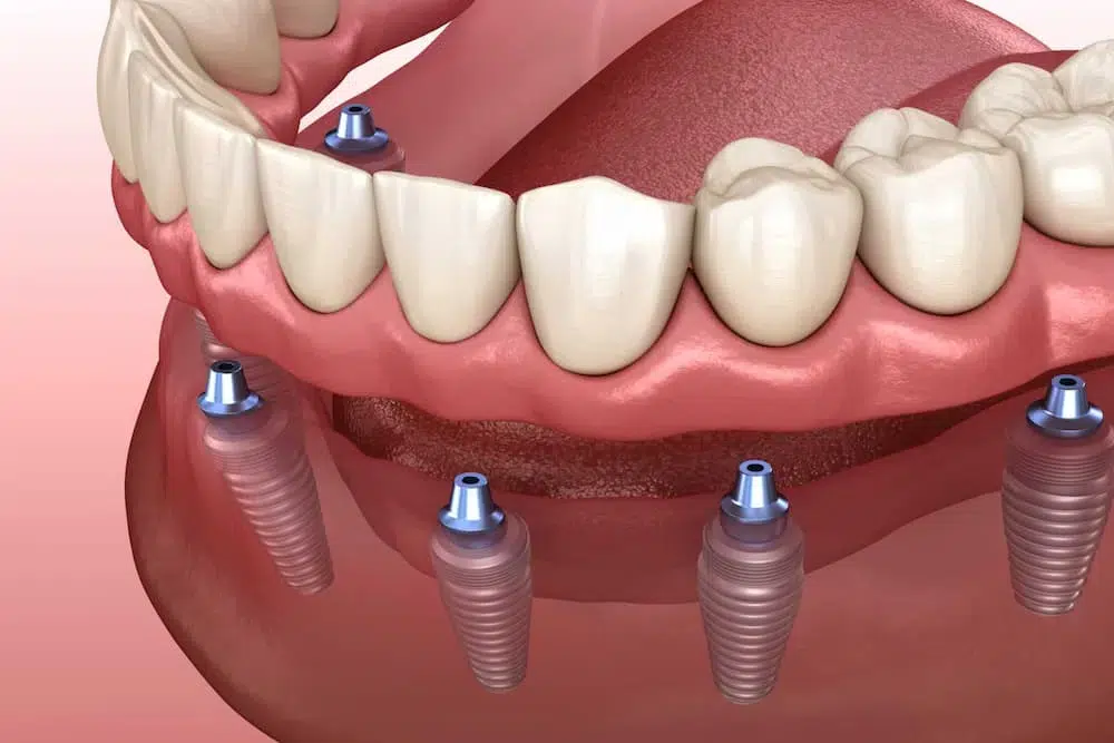 Zirconia scaled 1 1